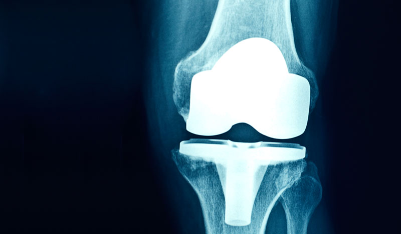 X-Ray of human leg