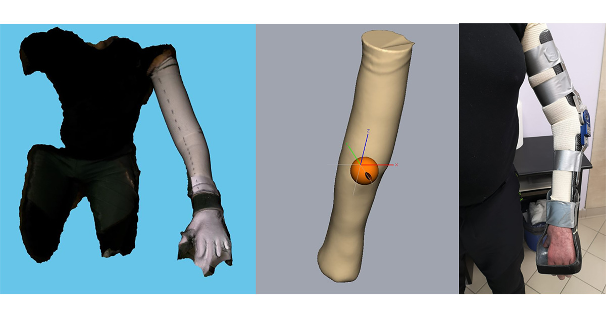 Driving digitalisation in orthotics and prosthetics with Geomagic ...