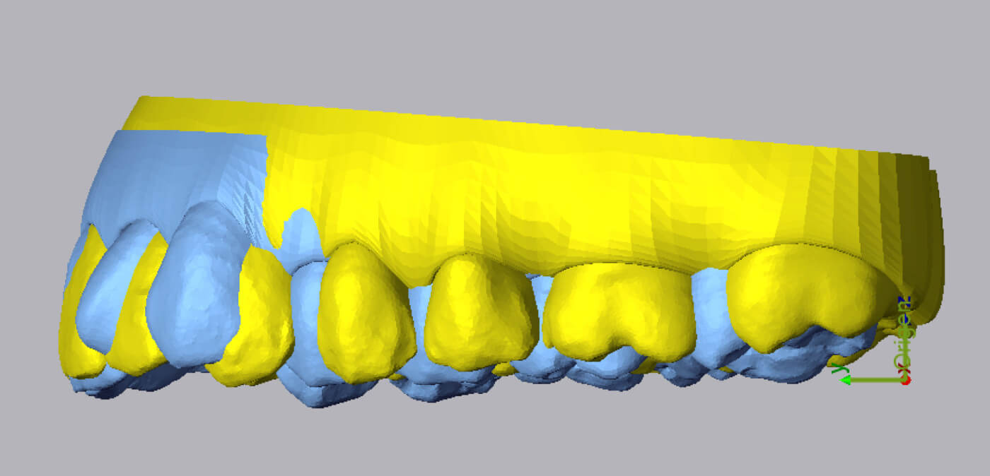 Superimposed-3D-scan-of-teeth-2