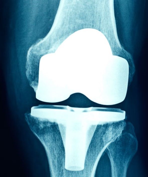 X-Ray image of a human bone